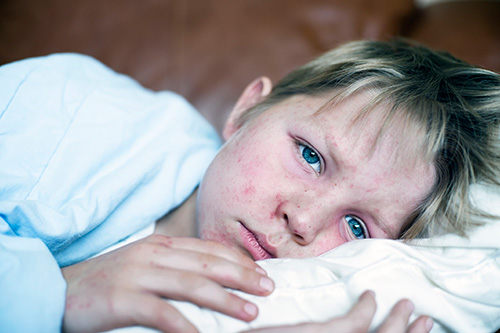 تصویری از یک پسر مبتلا به ویروس سرخک که روی رختخواب دراز کشیده