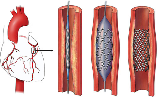 تصویر کامپیوتری از یک رگ قلب که به وسیله آنژیوپلاستی گشاد و باز شده