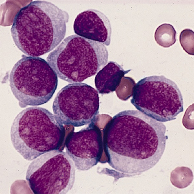 تصویری از سلول های سرطانی لوسمی