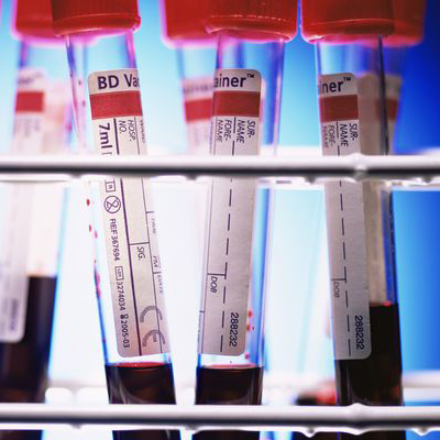 تصویری از شیشه های آزمایشگاه که حاوی خون است