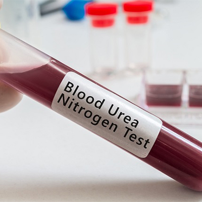 تصویری از یک شیشه آزمایشگاه که حاوی خون است و روی آن نوشته شده Urea (BUN)