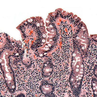 تصویری میکروسکوپی از بیماری سلیاک