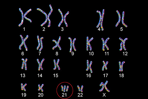 تصویری از کروموزم های بدن انسان که یکی از آنها عامل سندروم داون است
