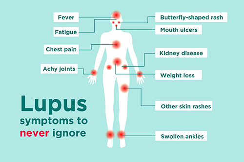 تصویری از علائم بیماری لوپوس که در تصویر نوشته شده